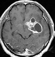 膠芽腫の造影MRI画像