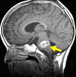 脳幹グリオーマの症例