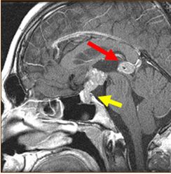 トルコ鞍から鞍上部（黄色矢印）、松果体部（赤矢印）に発生した胚腫