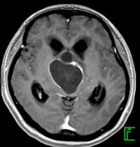 頭蓋咽頭腫の造影MRI　水平断