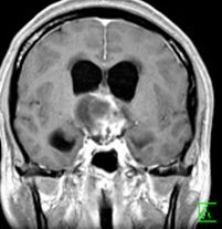 頭蓋咽頭腫の造影MRI　冠状断